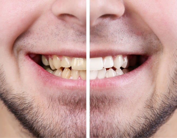 Blanchiment des dents - Centre Dentaire Delongchamp